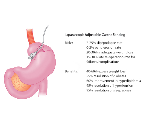 Figure 4. Risks and Benefits of Laparoscopic Adjustable Gastric Banding